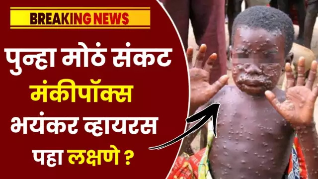 Monkeypox Virus in India